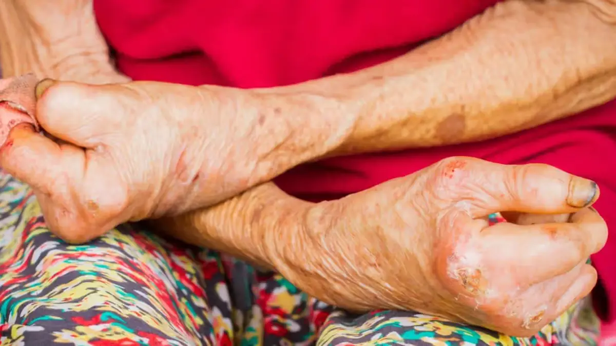 Delhi to Notify Leprosy as a Reportable Disease