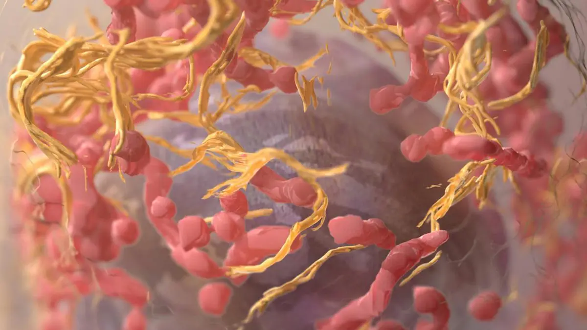 Melanoma: Cholesterol’s Role in Cancer Spread