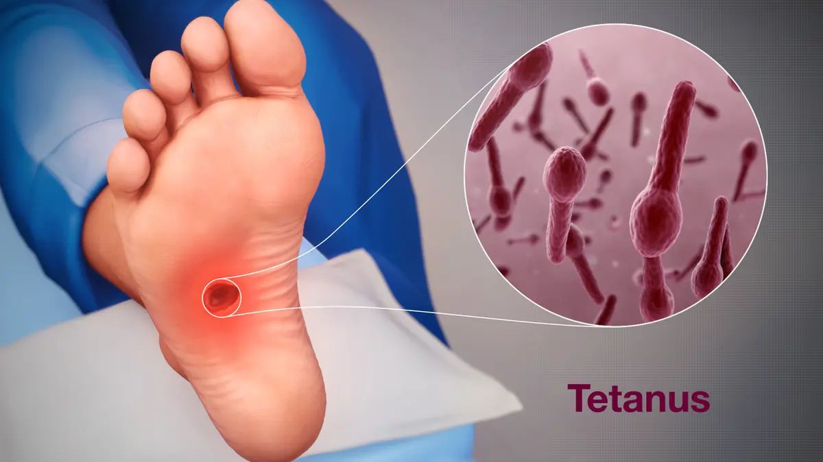 Tetanus resurgence draws attention to vaccine boosters