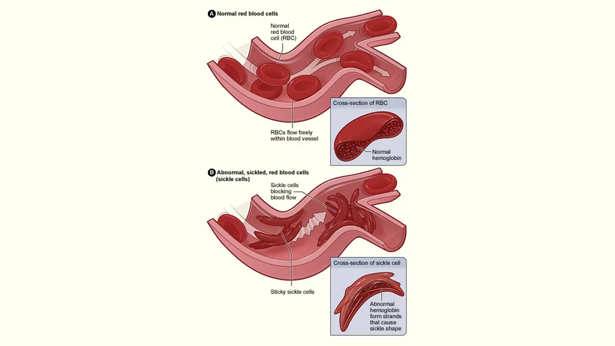 BIRSA-101: Sickle Cell Disease, CRISPR & Gene Therapy