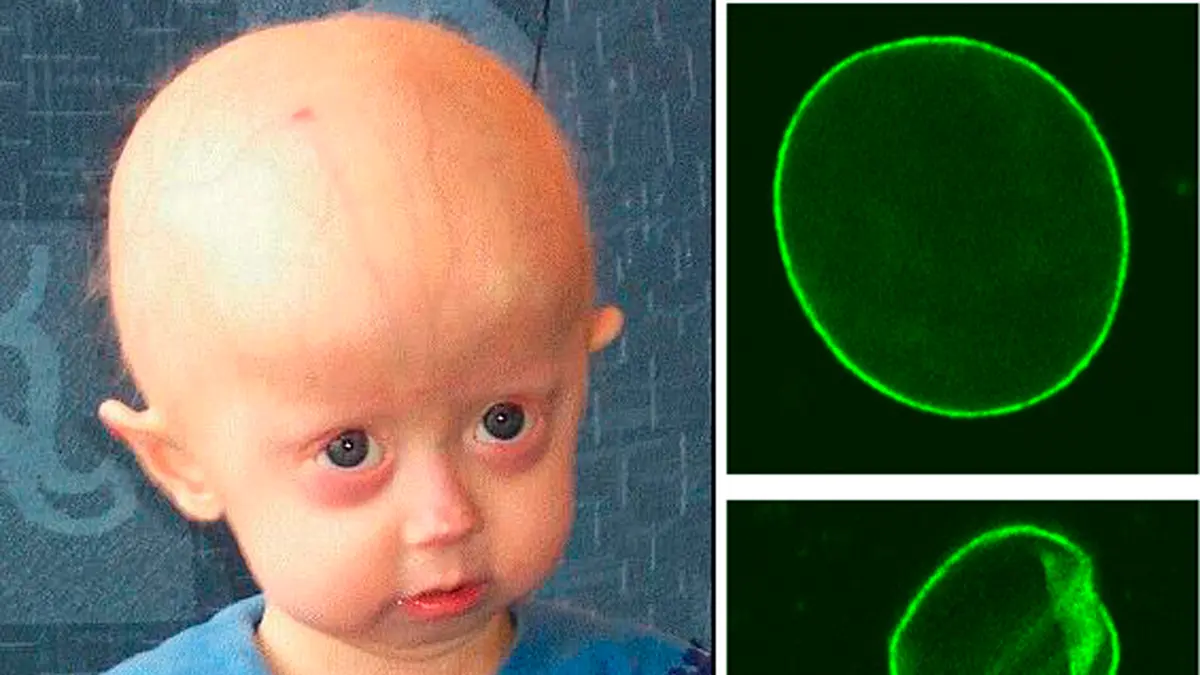 Hutchinson–Gilford Progeria Syndrome (HGPS) and Progerinin