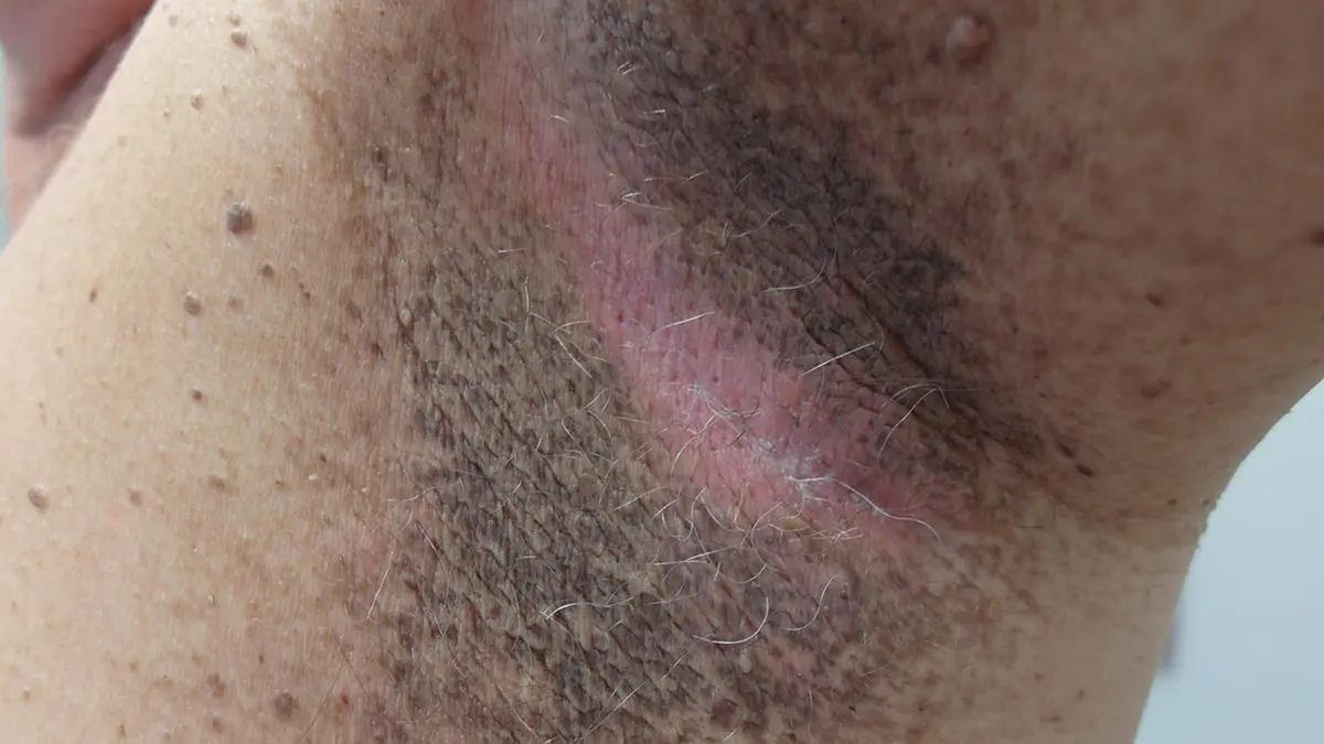 Acanthosis Nigricans