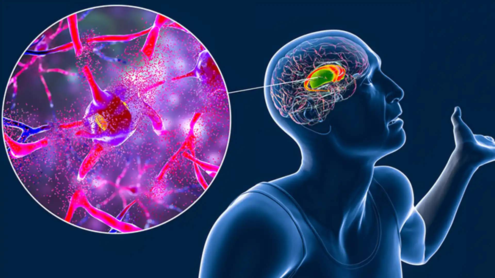 Huntington’s Disease and Gene Therapy Trials