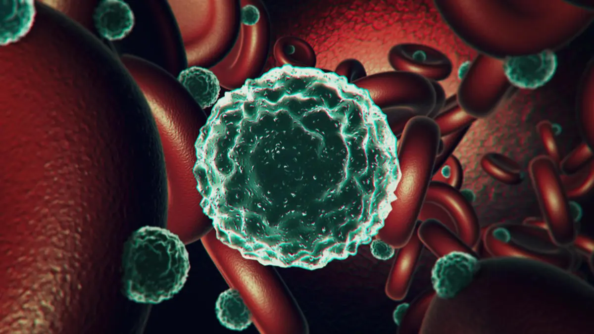 Sickle Cell Disease – Stem Cell Transplant Breakthrough