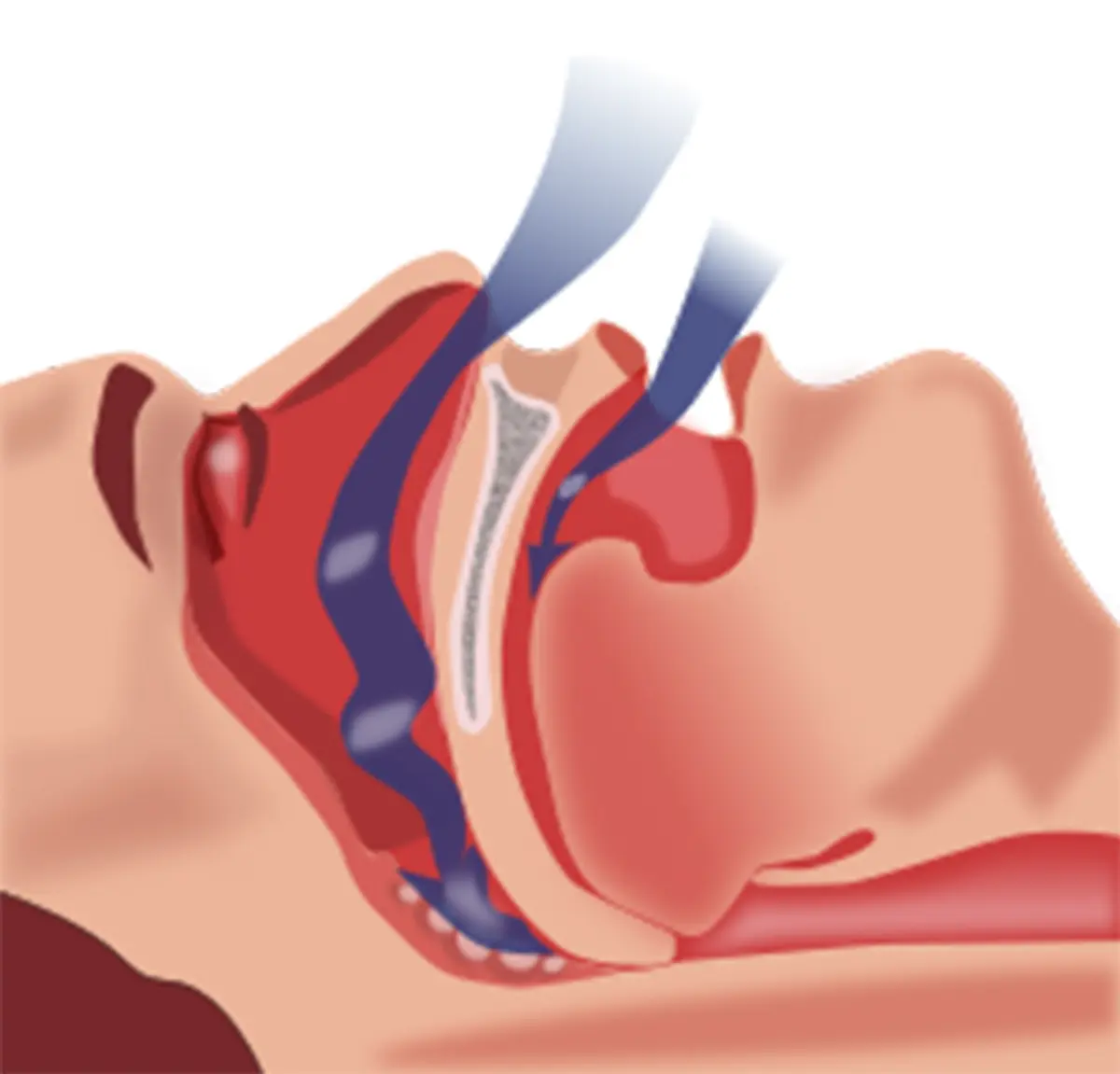 Obstructive Sleep Apnea and the Risk of Parkinson’s Disease