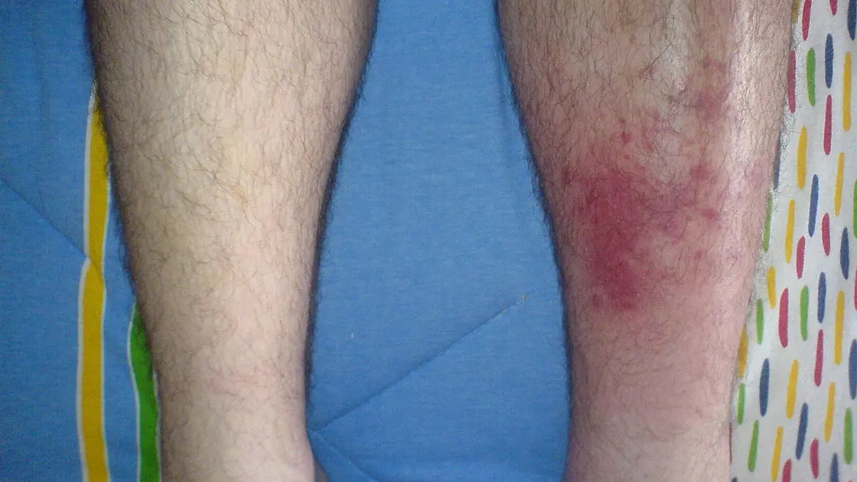 Cellulitis – a common skin infection