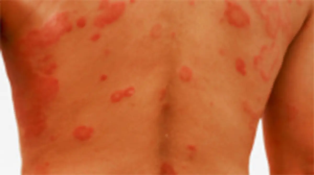 AI‑Based Diagnosis for Autoimmune Blistering Diseases