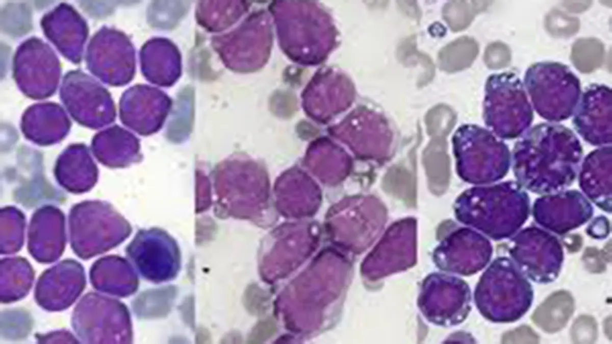 Acute Lymphoblastic Leukaemia (ALL) – Understanding the Disease and New Findings