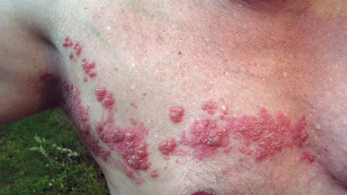 Shingles Vaccine Linked to Lower Dementia Risk