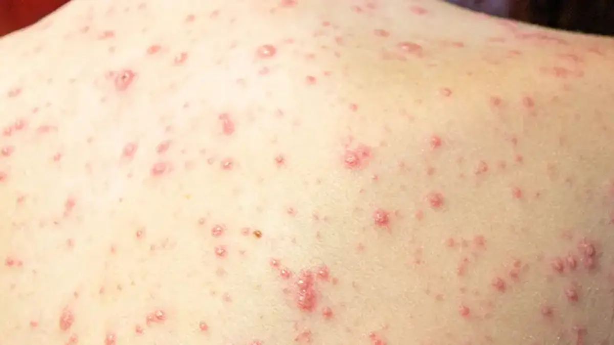 World Lupus Day highlights the need for awareness and early care