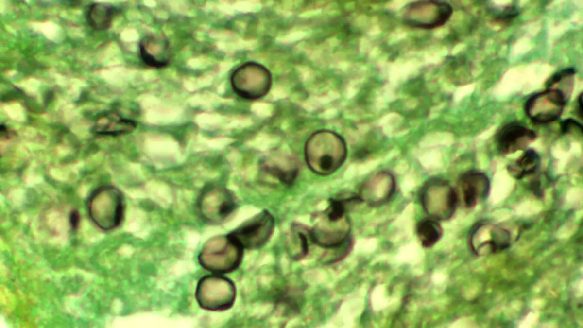 Pneumocystis jirovecii: Fungus Gains Resistance to a Transplant Drug