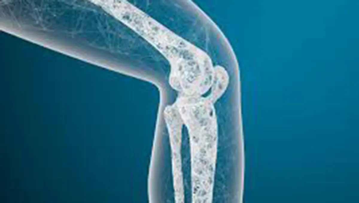 Exercise Sensor Discovery Offers Hope Against Osteoporosis