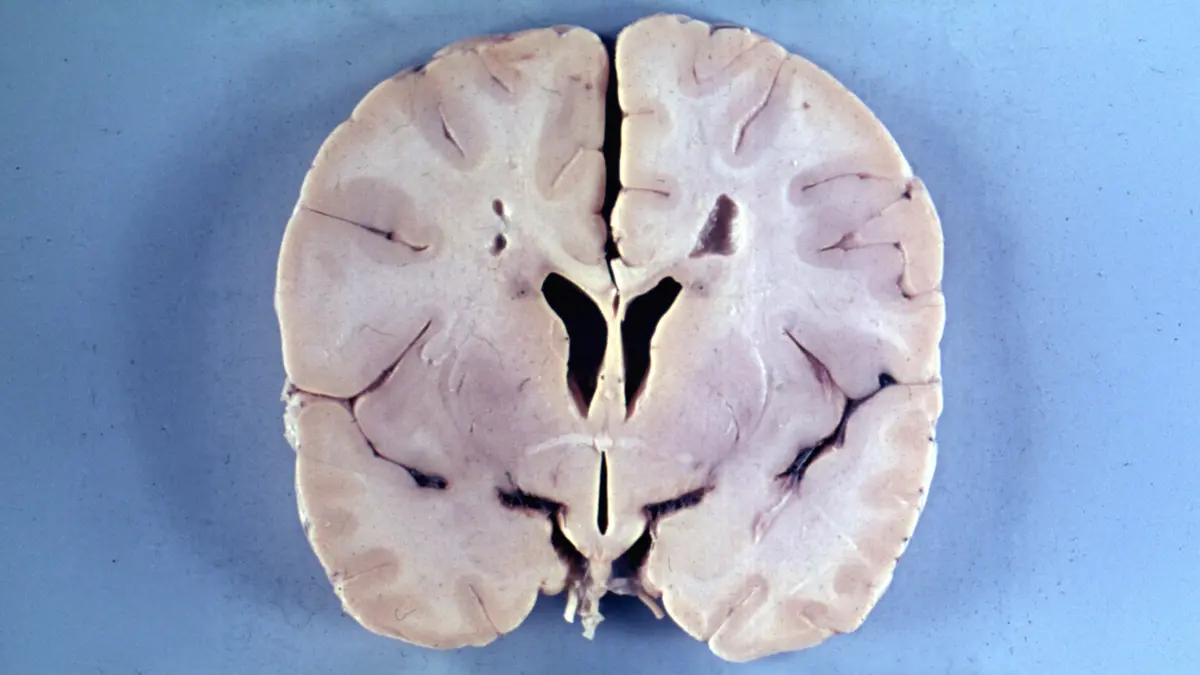 Zanvastro: First US Approval for Alexander Disease Therapy