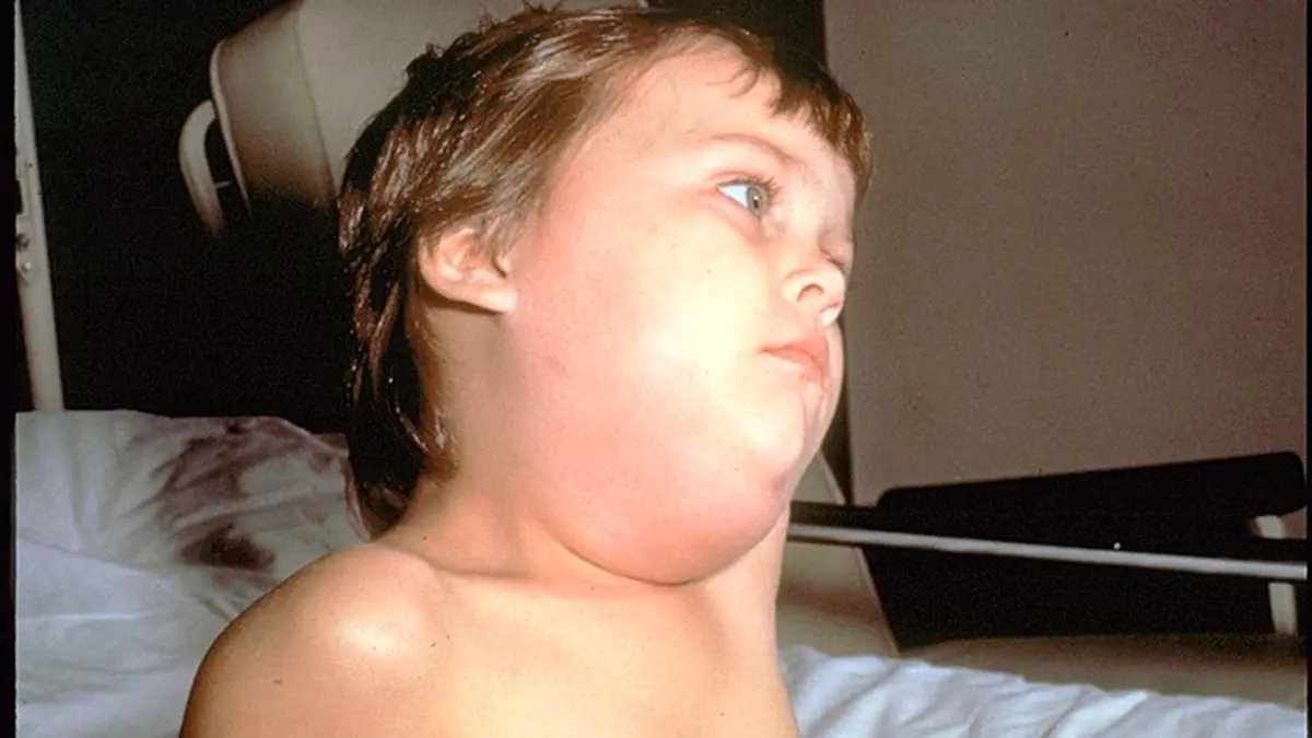 Mumps outbreak in Maryland highlights vaccination needs