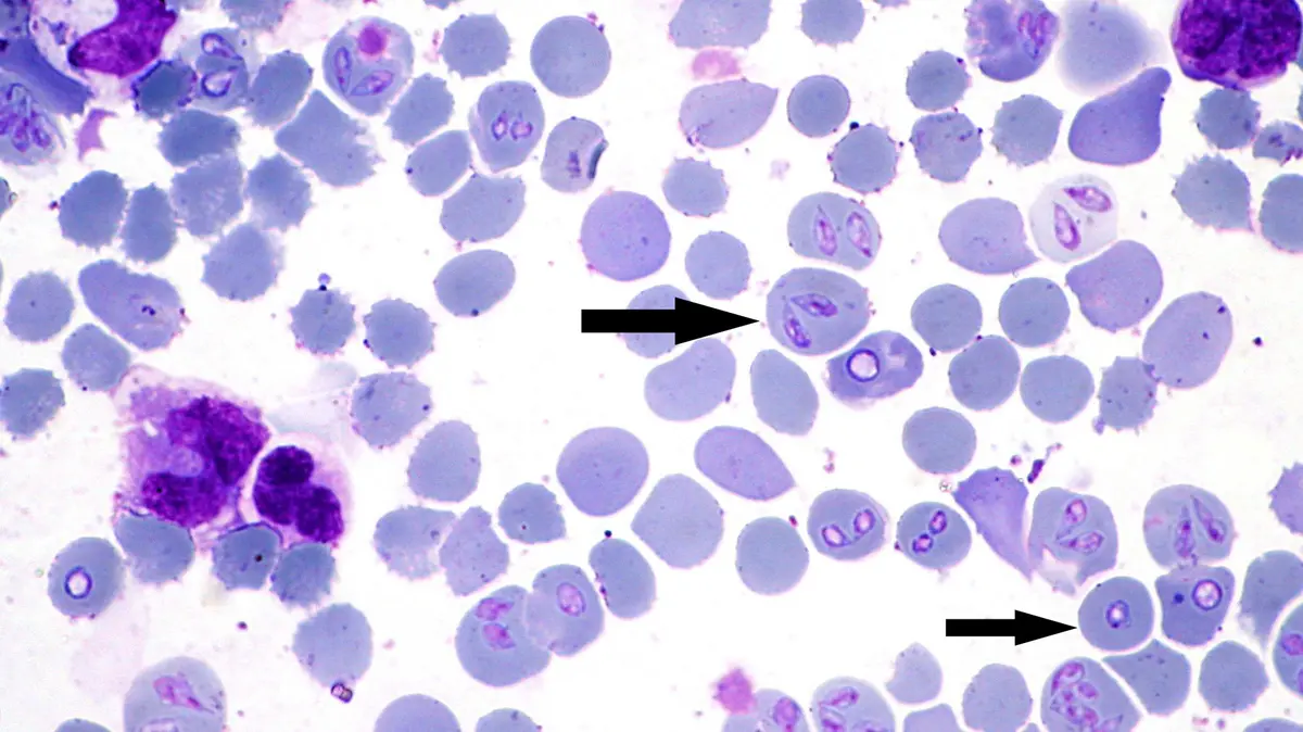 Babesia Outbreak and Basics of Babesiosis