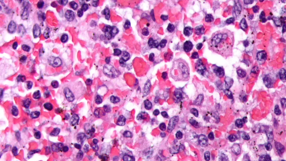Hemophagocytic Lymphohistiocytosis (HLH)