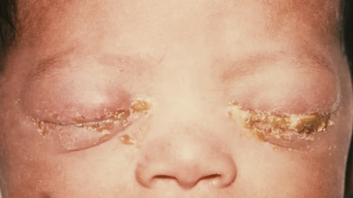 Two New Oral Medicines Approved for Gonorrhoea