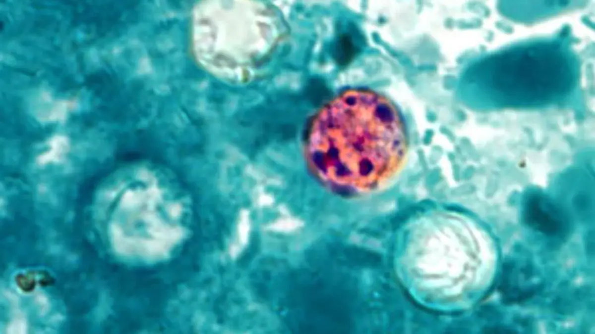Cyclosporiasis