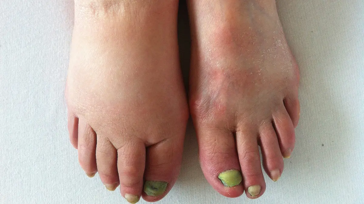 Lymphedema – New Hope for Treatment