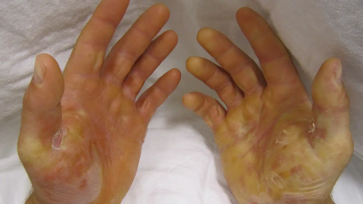Epidermolysis Bullosa: ICMR Grant Funds ADAPT-EB Project