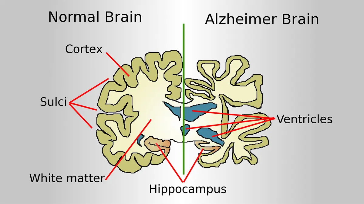 Alzheimer's Disease: ADxFluor Platform, TZ-48 Molecule & Uses