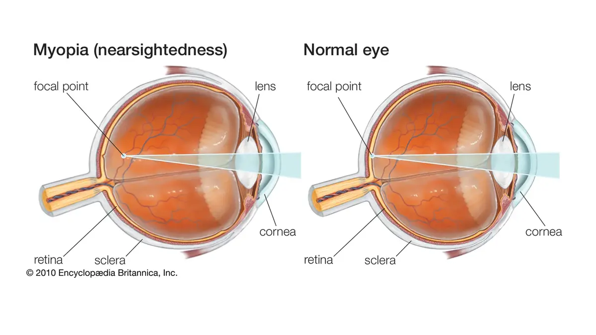 Myopia: Causes, Prevention & Nearsightedness Details