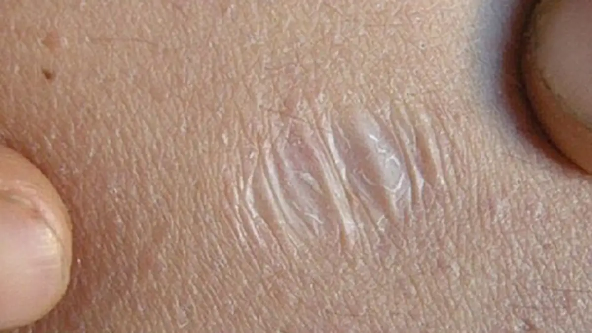 Ehlers-Danlos Syndrome: Three Studies Probe the Hypermobile Type
