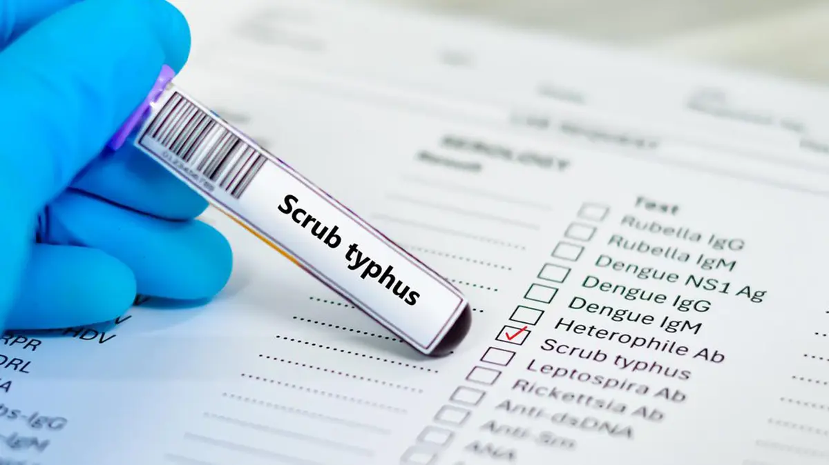 Scrub Typhus: A Mite-Borne Fever That Needs Early Treatment