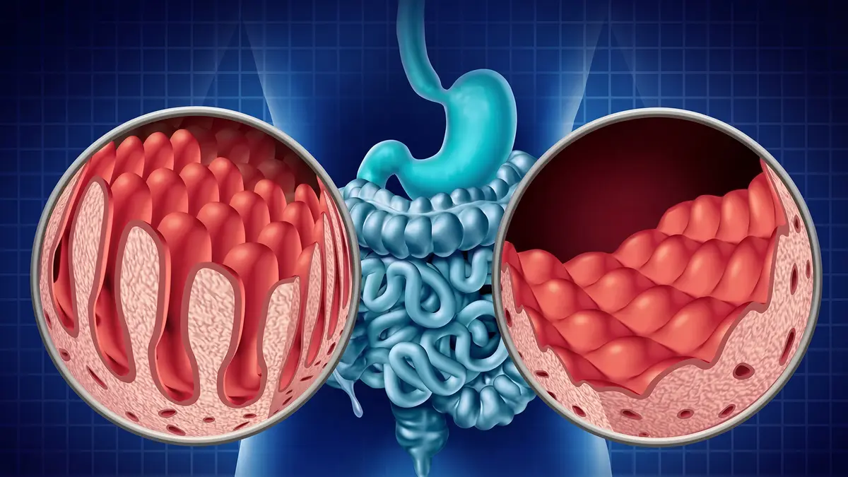 Celiac Disease – An Autoimmune Response to Gluten
