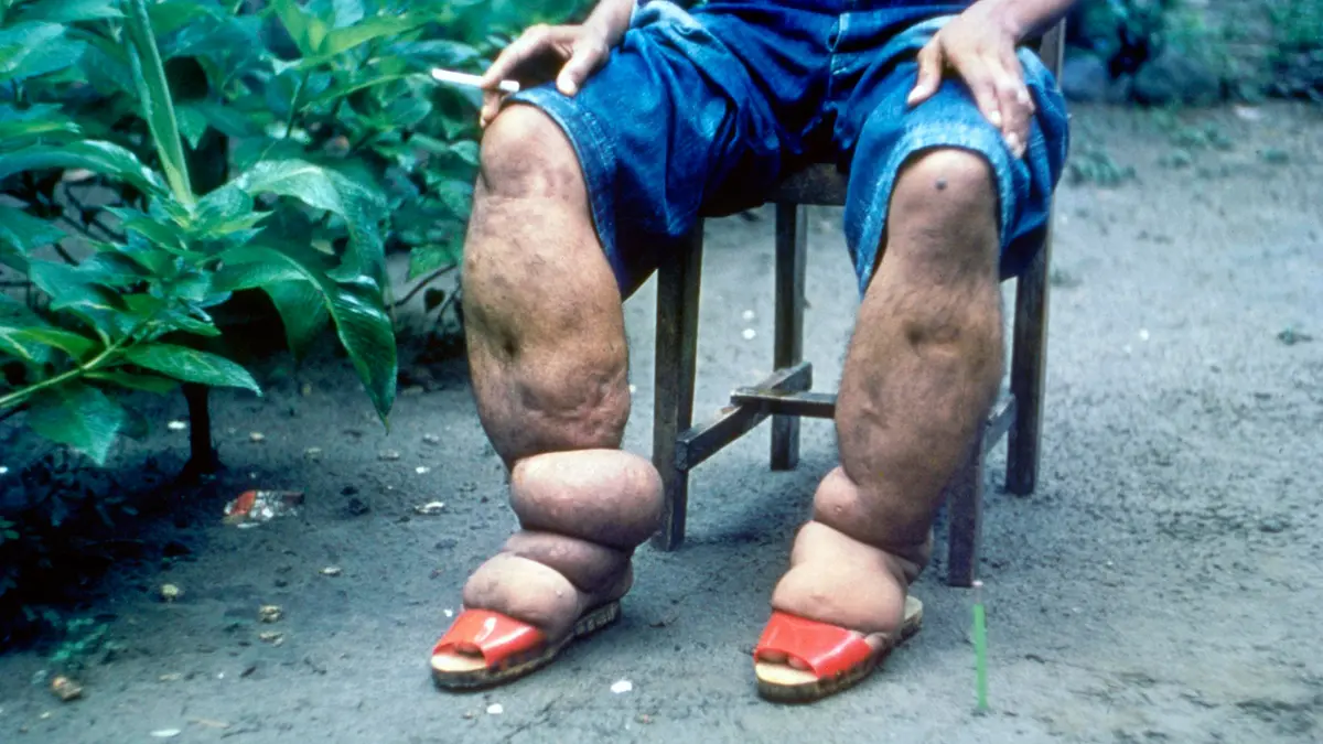 Lymphatic Filariasis – India’s Campaign to Eliminate a Neglected Disease