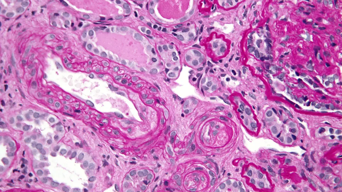 Antiphospholipid Syndrome – an autoimmune clotting disorder