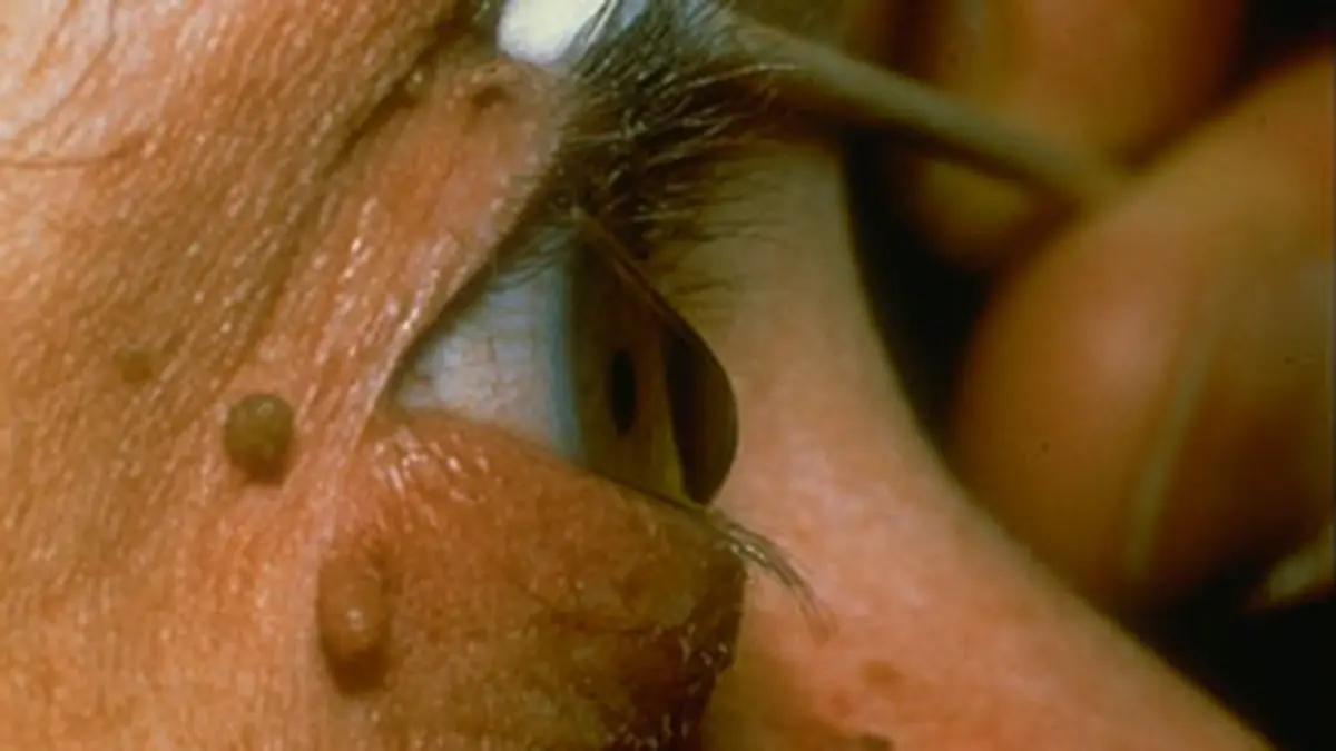 Keratoconus Study