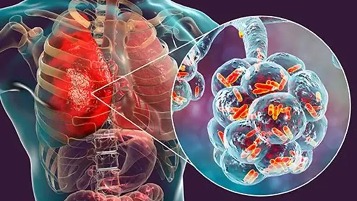 Legionnaires’ Disease