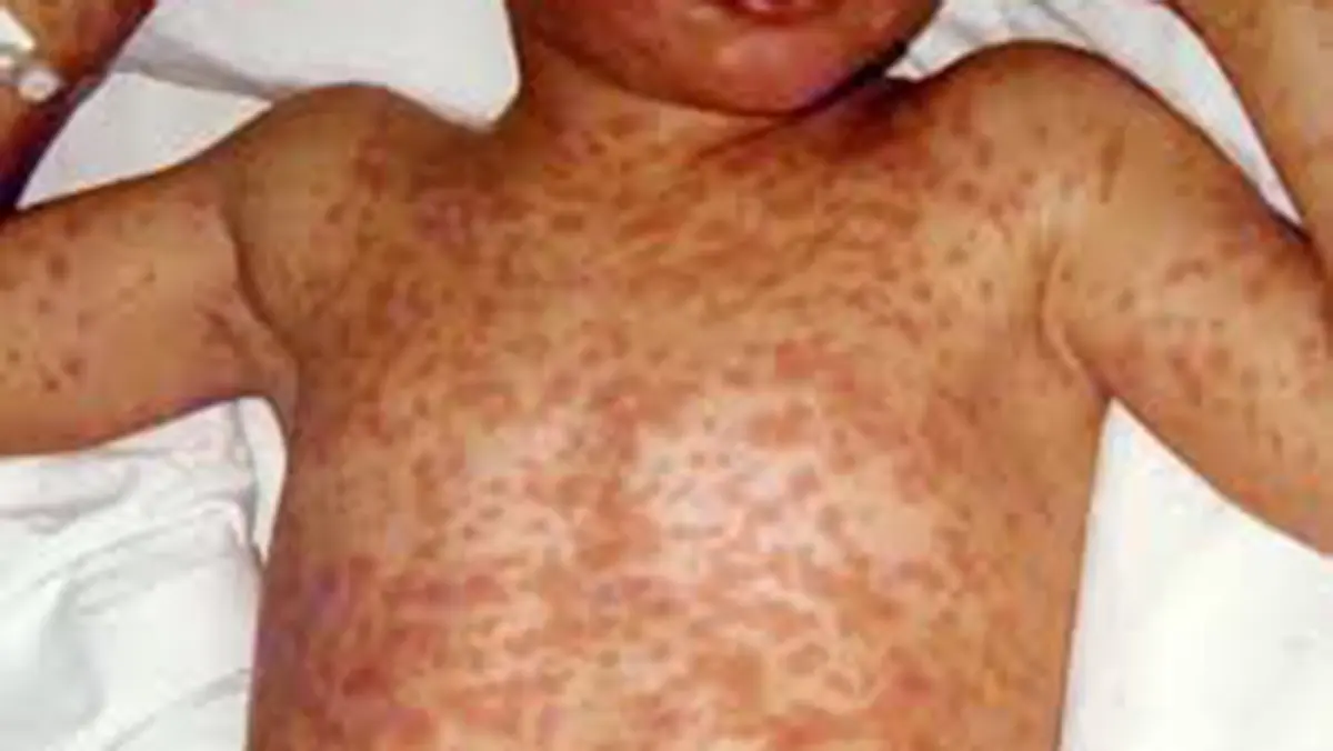 Measles – Outbreaks highlight the need for timely vaccination
