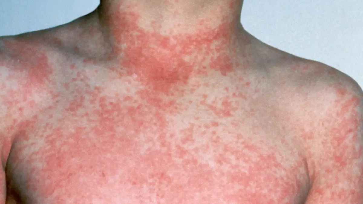 Ancient Evidence of Scarlet Fever in a Bolivian Mummy