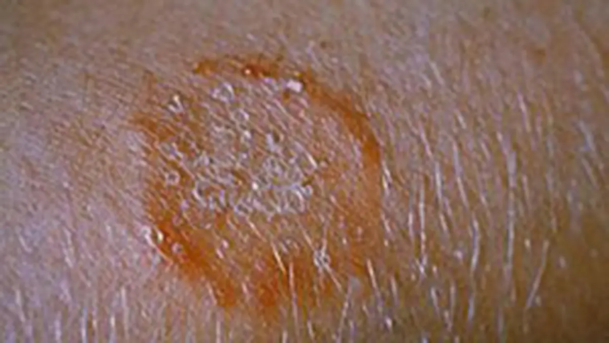 Dermatophytes: Ringworm and the Rise of Antifungal Resistance