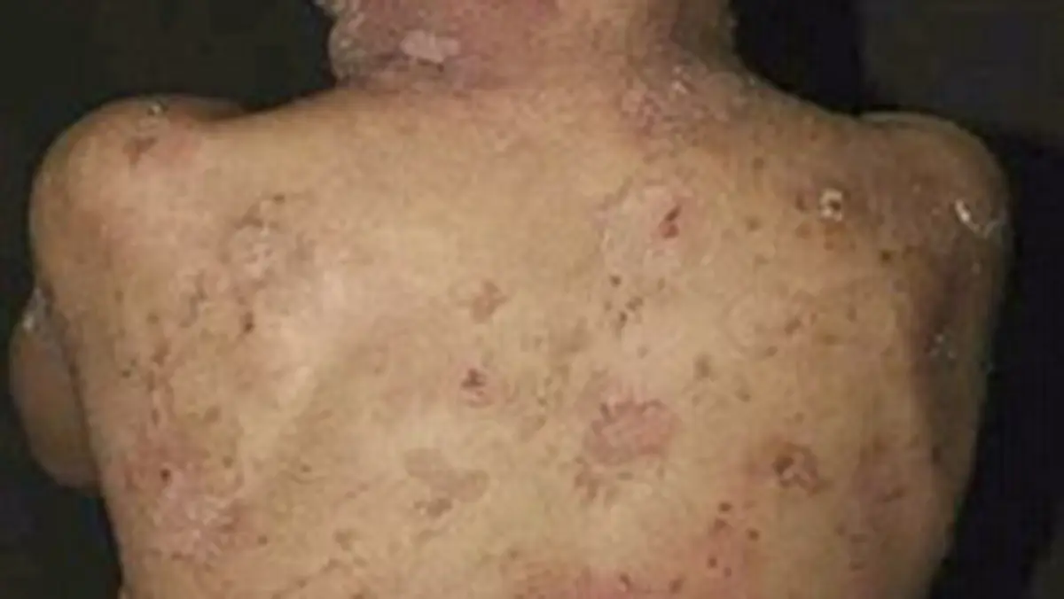 Hyperkeratosis
