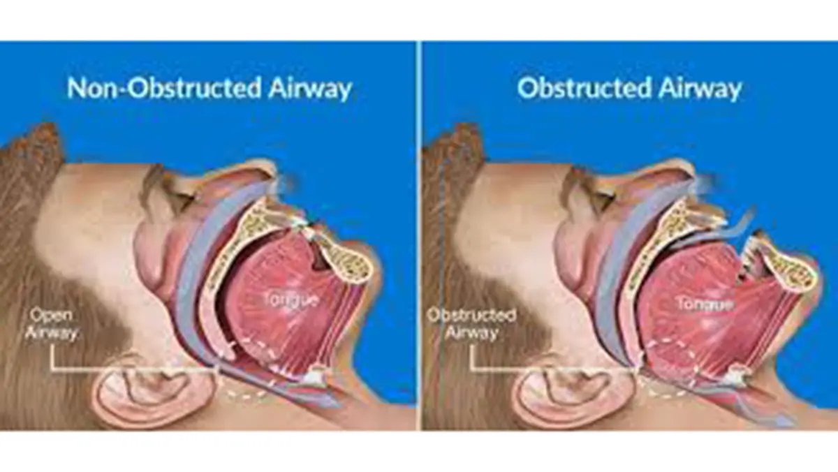 Obstructive Sleep Apnea – New study warns of increased heart risk