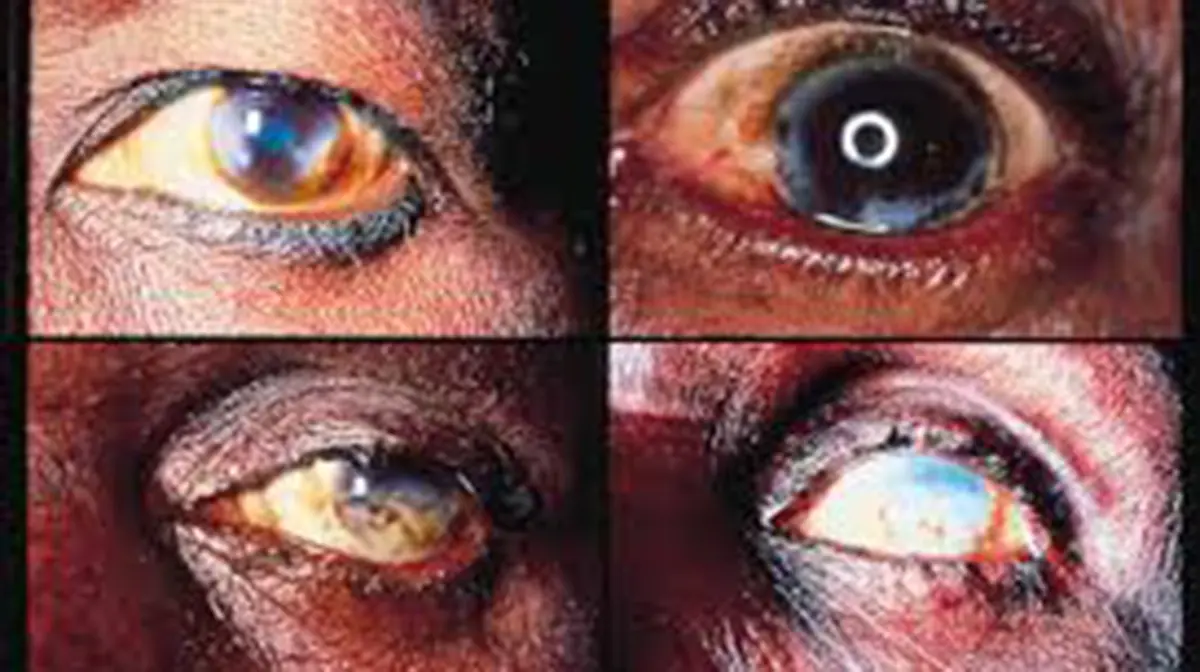 Onchocerciasis Elimination in Niger