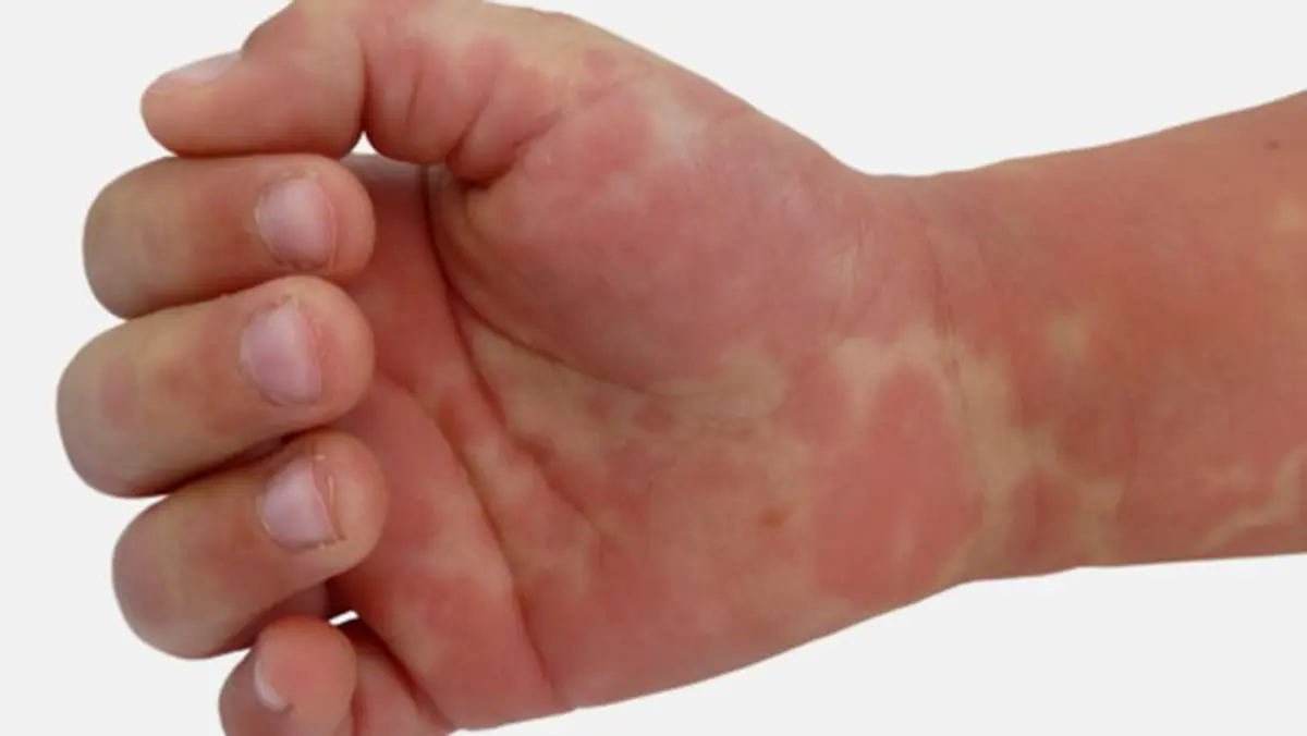 Kawasaki Disease and Prednisolone Trial