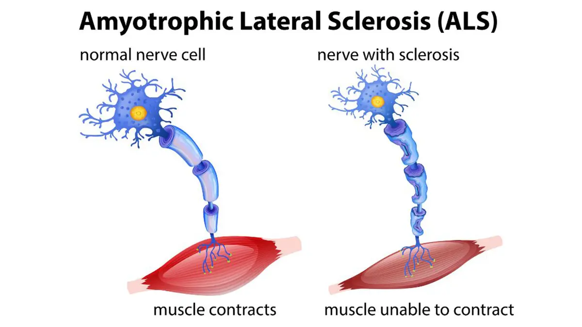 ALS and Pesticides: What a Meta-Analysis Can Actually Show