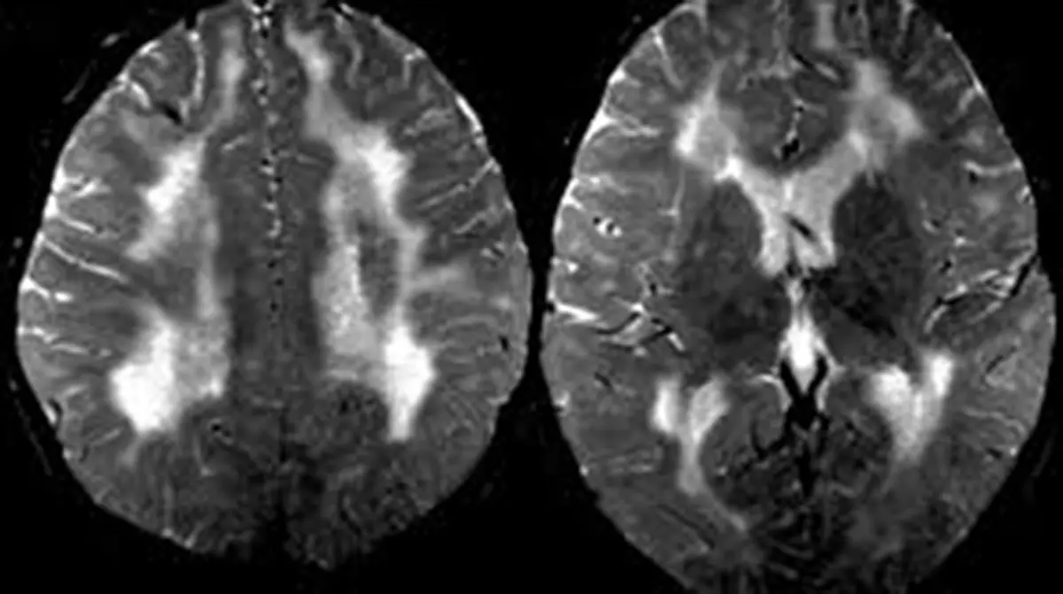 Subacute Sclerosing Panencephalitis (SSPE)