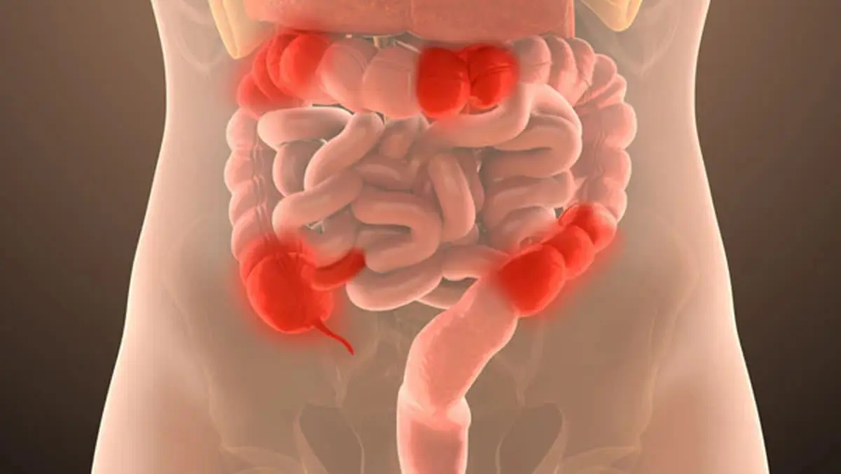 Crohn’s Disease – Understanding and Emerging Therapies